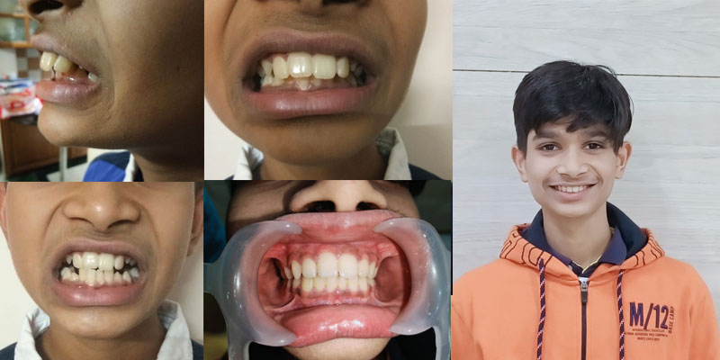Teeth Treatments
